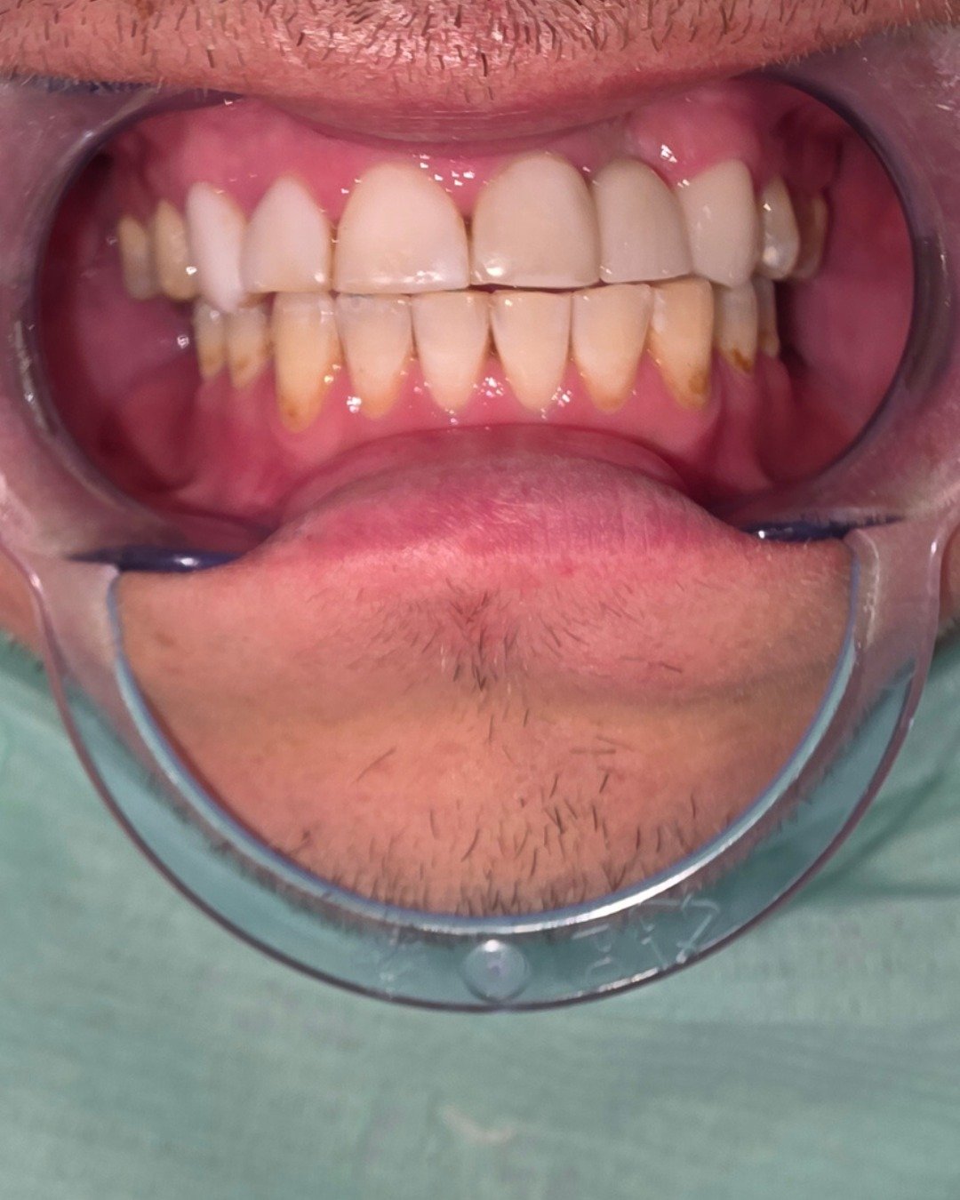 Después del tratamiento dental