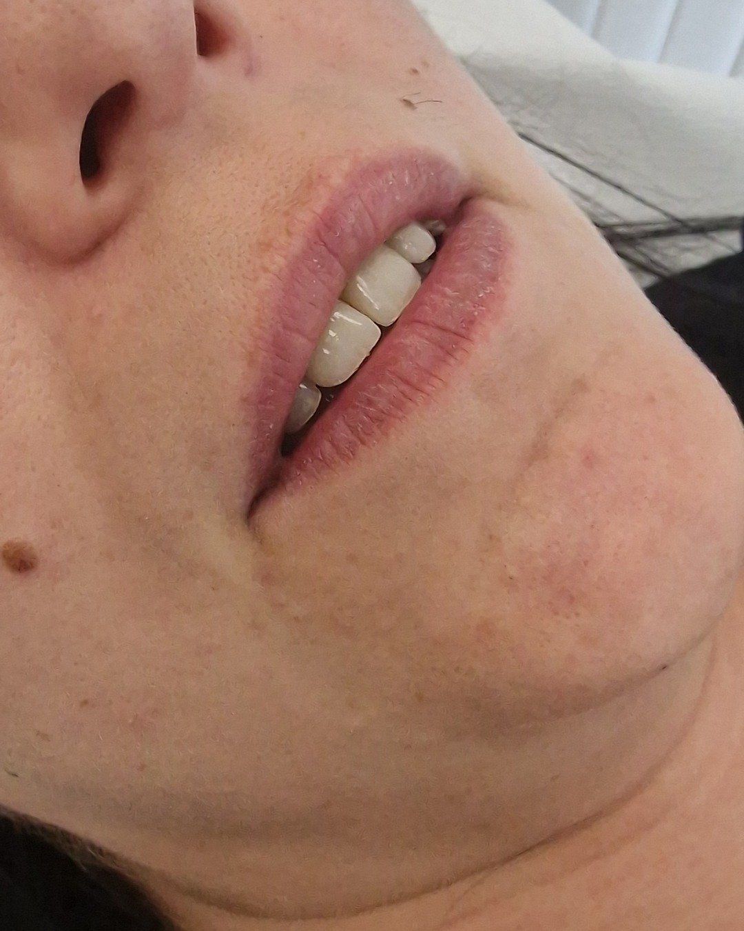 Antes del aumento de labios