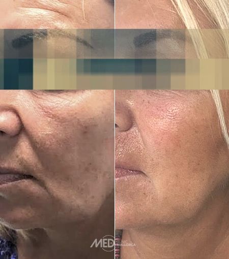 Tratamiento-Hilos-Tensores-antes-y-despues-Clinica-Mallorca-MED-Palma Tratamiento-Hilos-Tensores-antes-y-despues-Clinica-Mallorca-MED-Palma